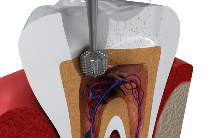 Dental Root Canal Treatment